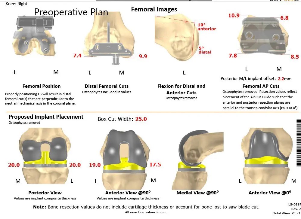 Time for a total knee replacement? Mayo Clinic Health.