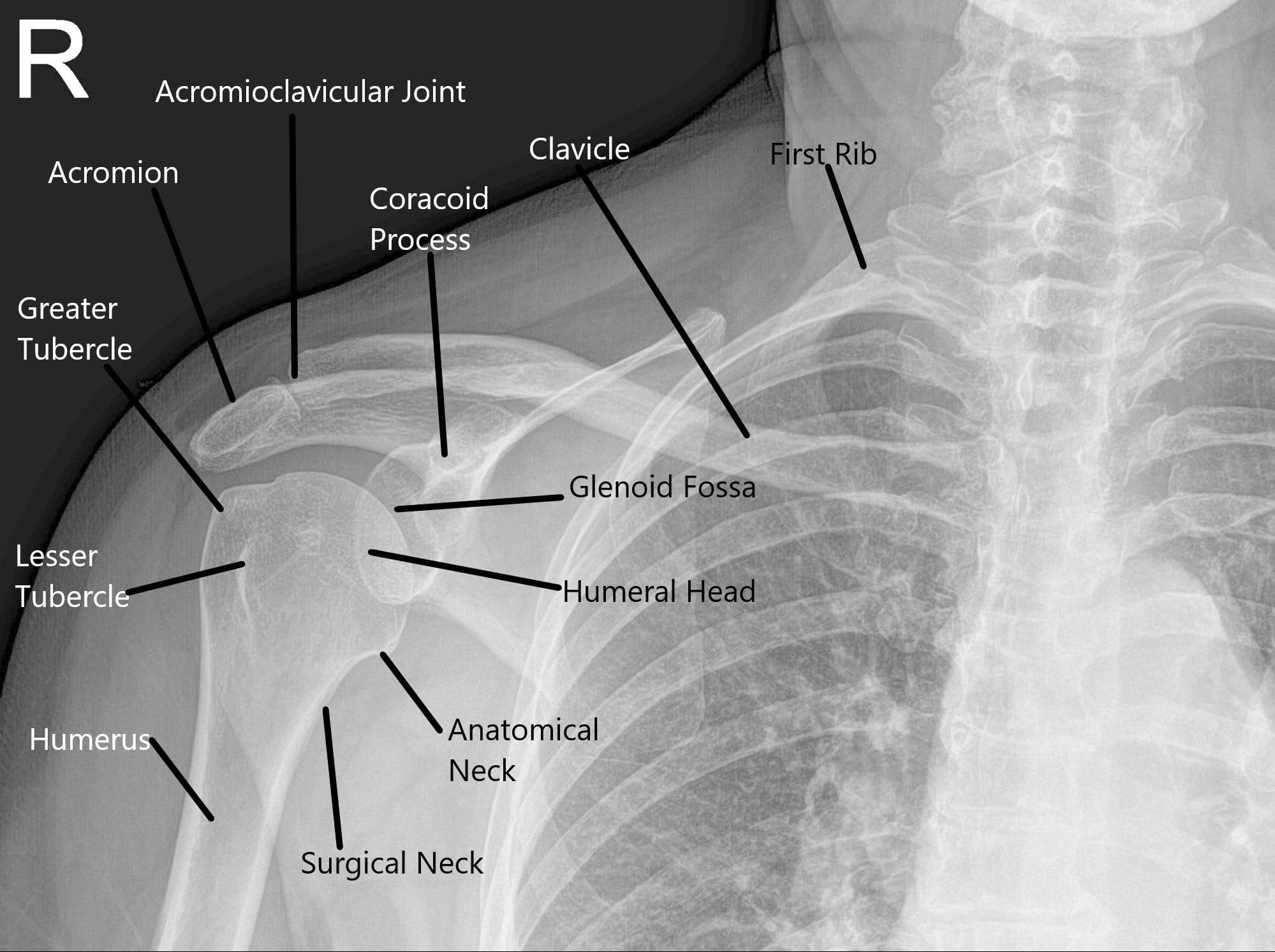 Snapping Shoulder Causes & Management Complete Orthopedics