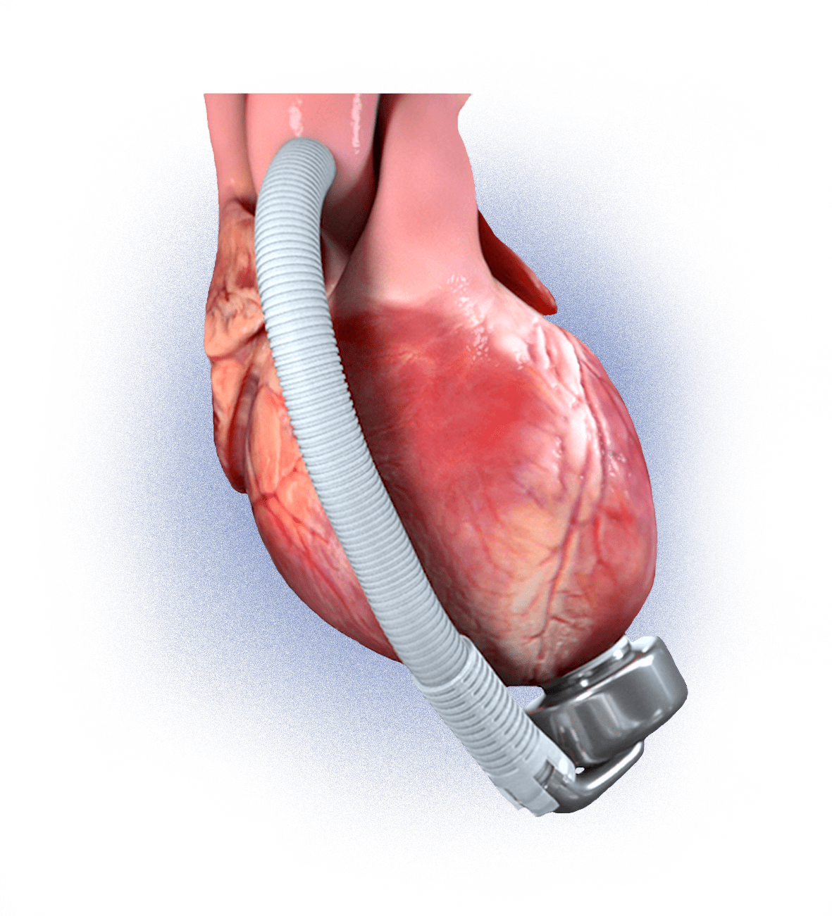 Lvad