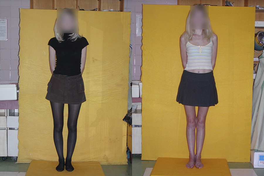 Operative correction of bowed legs or knock knees photos