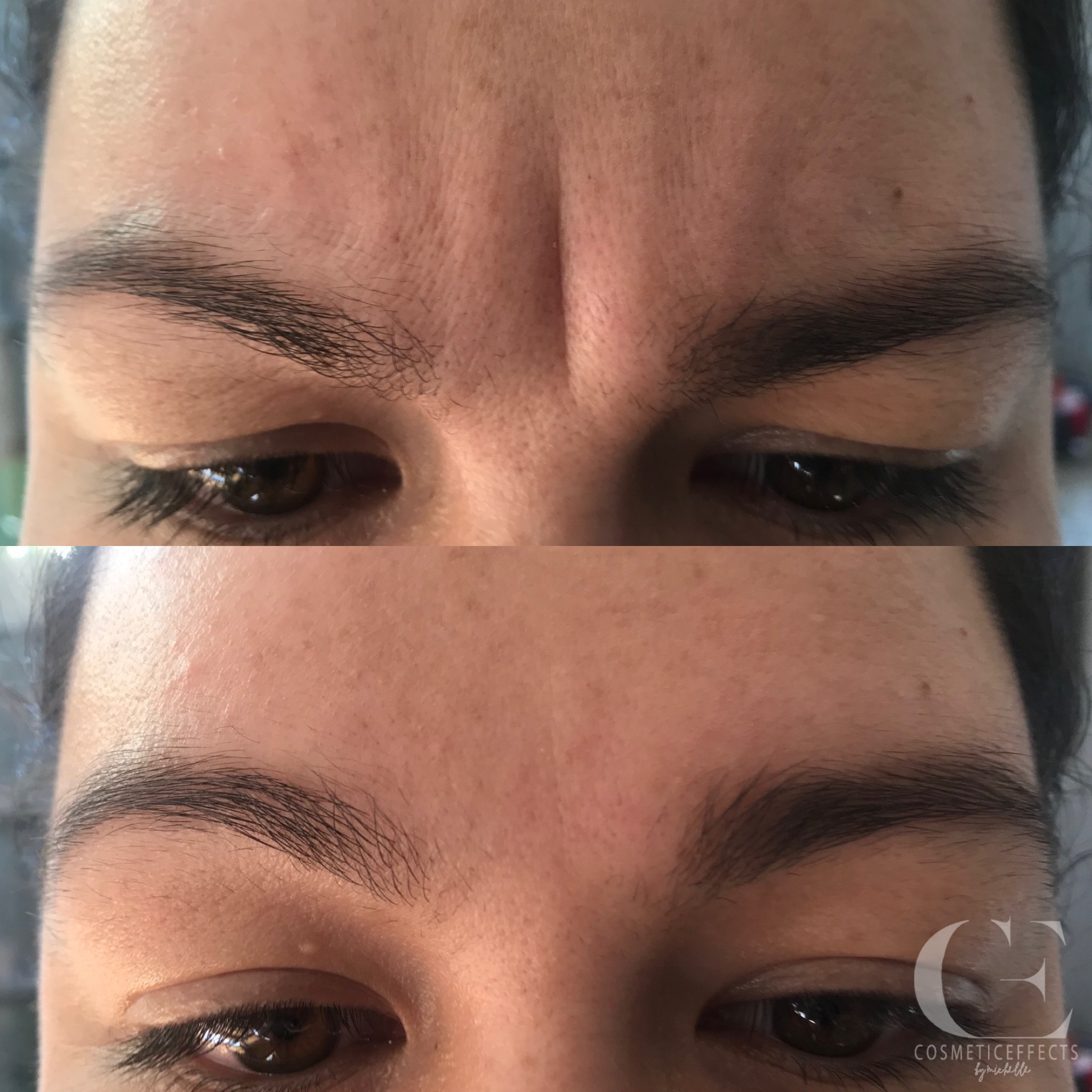 Gallery Cosmetic Effects Cosmetic Injector Melbourne