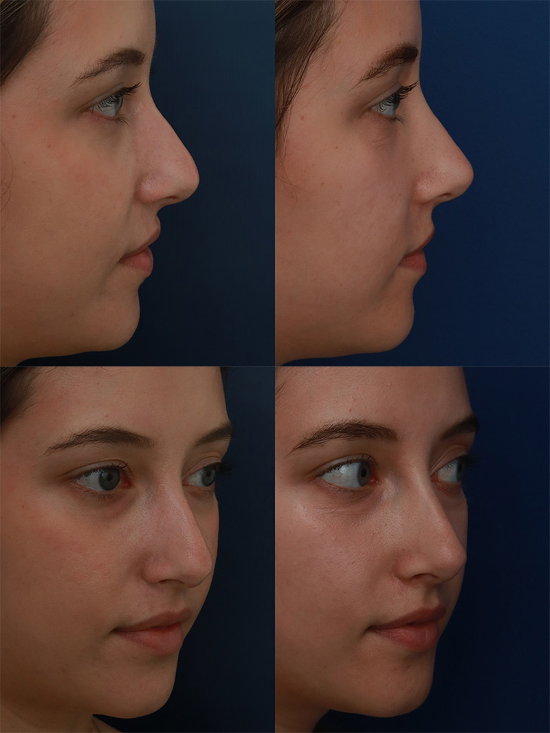 NonSurgical Rhinoplasty Baltimore MD Liquid Rhinoplasty