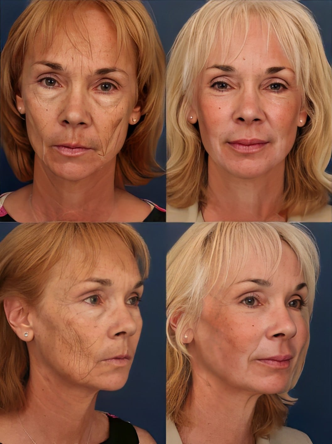 Laser Dermabrasion