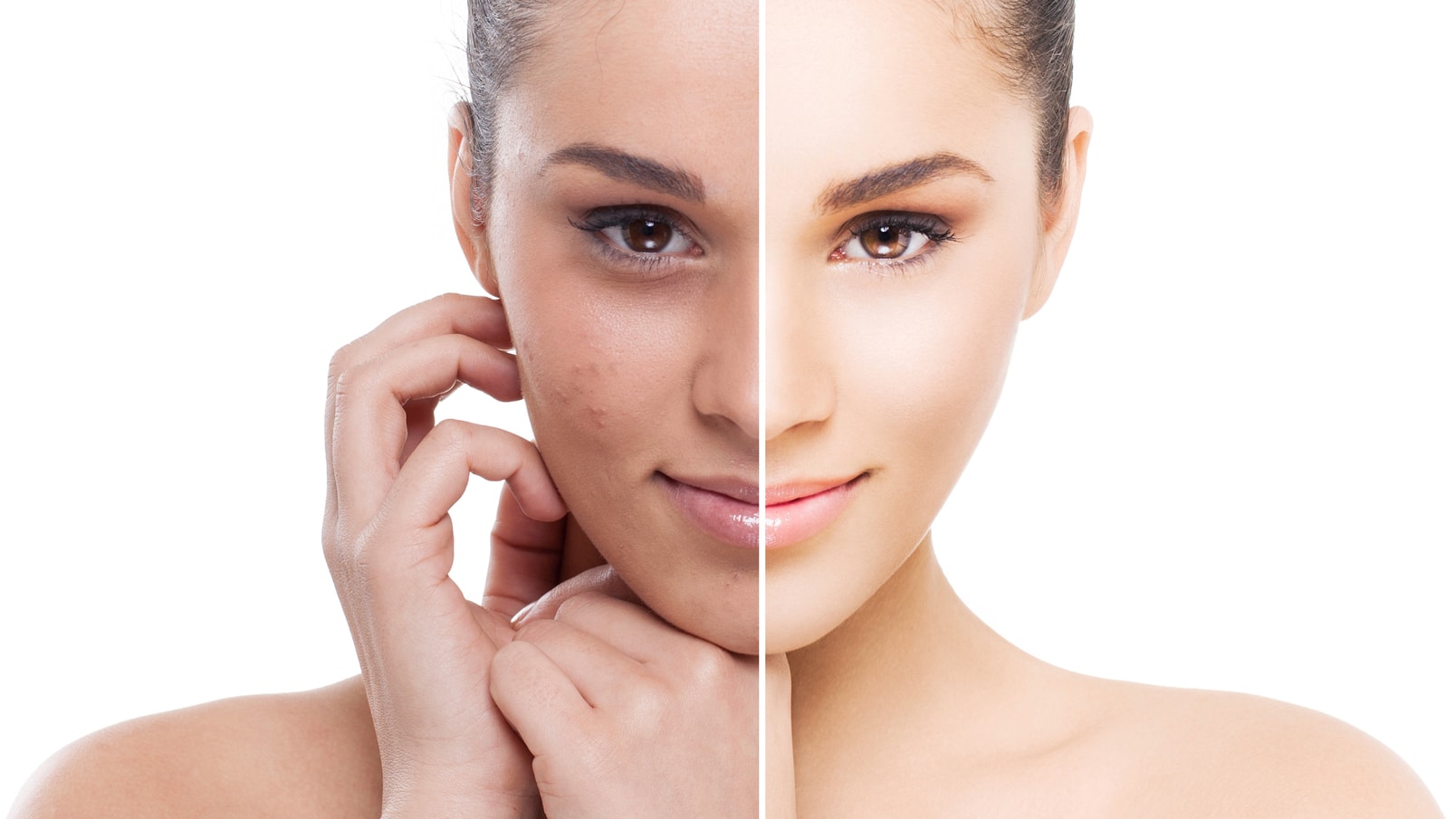 Learn How Deep Chemical Peels Fix Imperfections On The Face Cosmetic Town