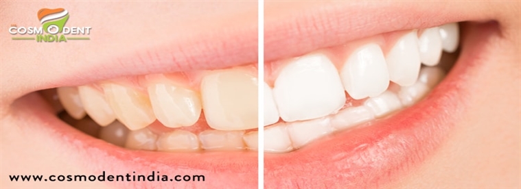 Dentists Teeth Whitening Costs TeethWalls