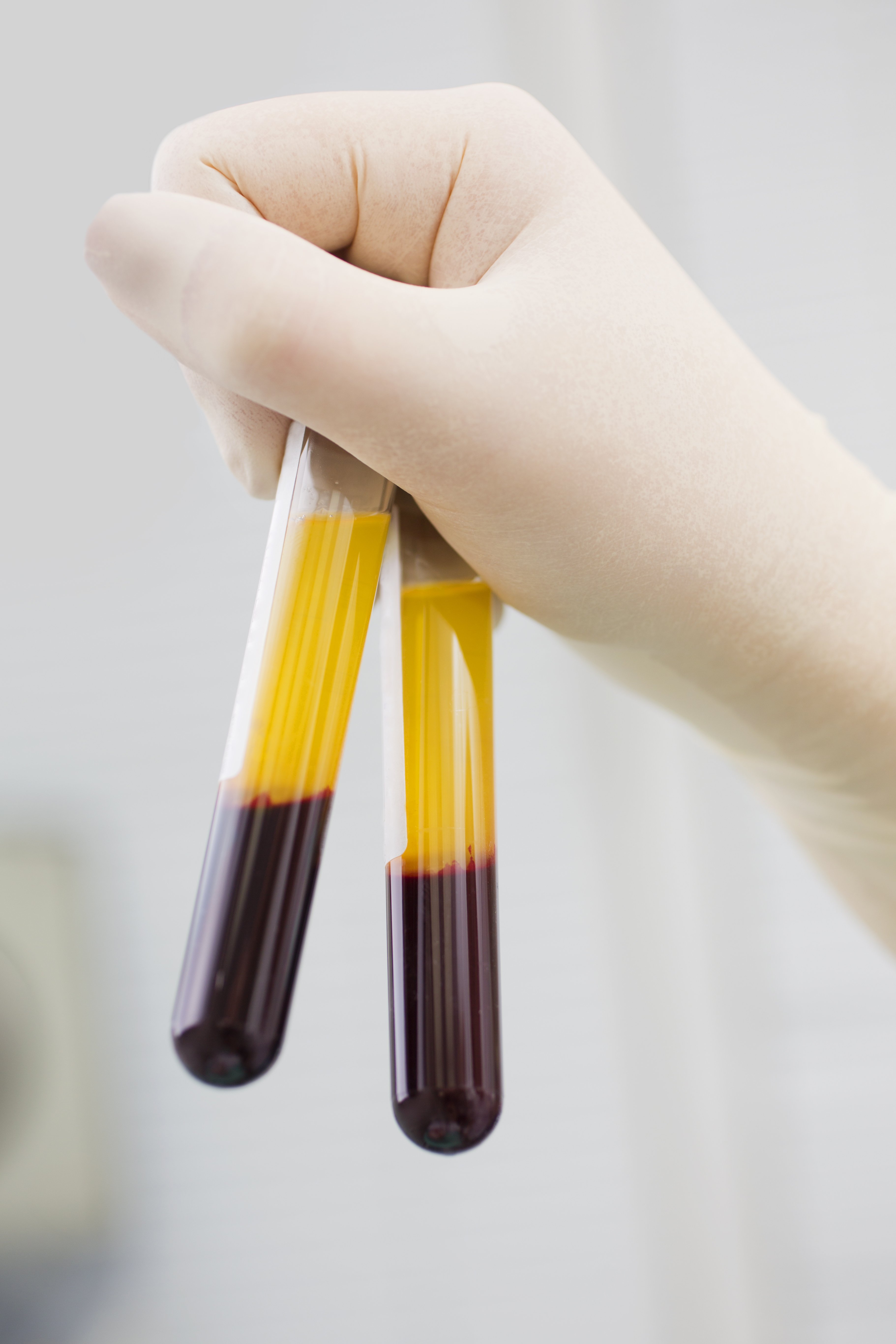 Blood tubes in two layers divided by centrifuge after Cotswold Trichology
