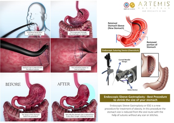 Artemis Hospital Performs North India's First Endoscopic Sleeve Gastroplasty (ESG) Covaipost
