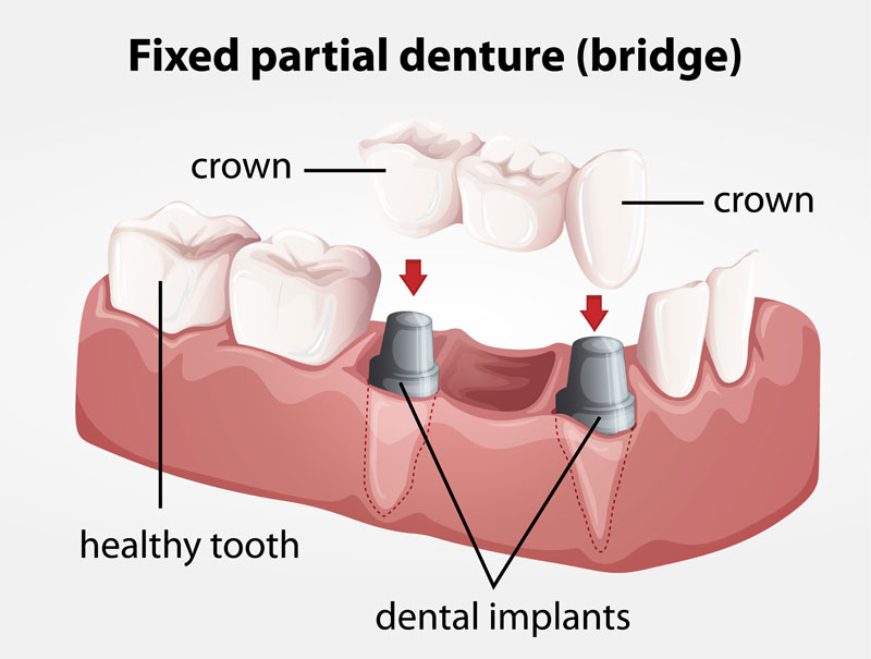 Bridges Palmyra Laser Dentistry