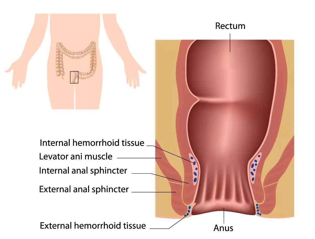 External Hemorrhoids Before And After