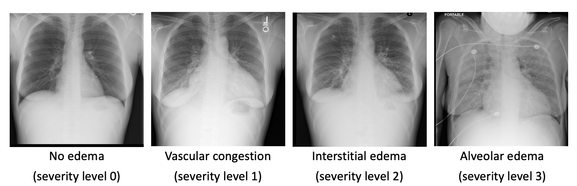 Pulmonary Edema Vs Normal Chest X Ray