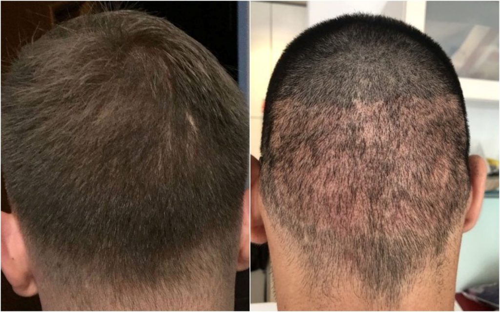 How to choose the best and affordable Hair Transplant?