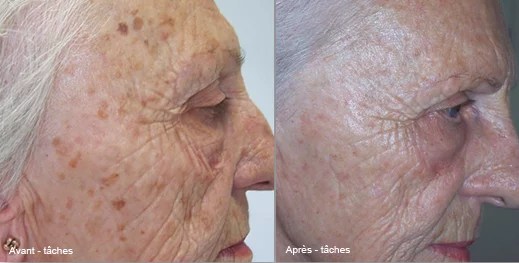 Radiofréquence fractionnée esthétique du visage CSHP Paris