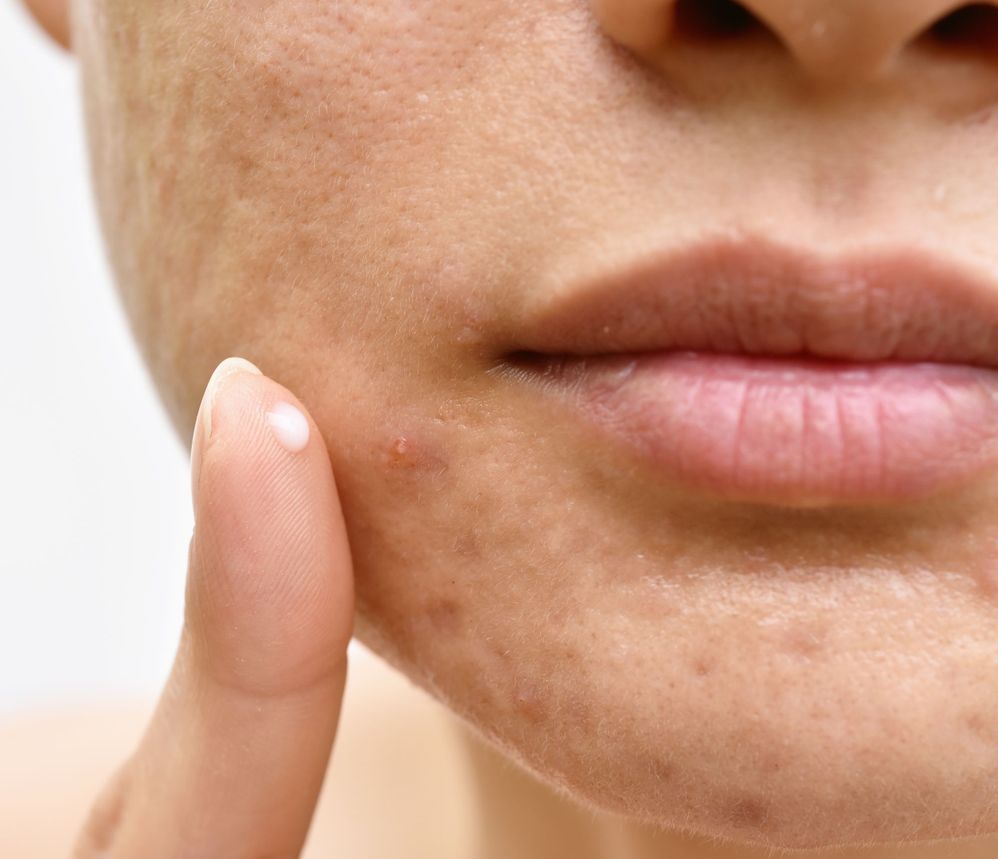 Top 6 Acne Supplements for Clear, Beautiful Skin Vitamin C, D, E, Fish Oil, Evening Primrose