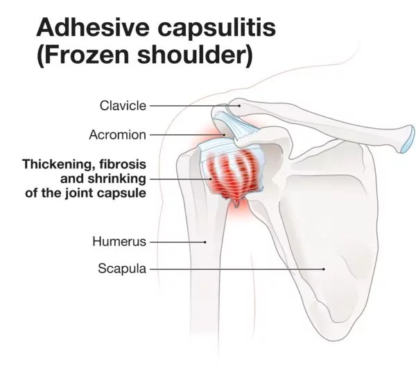 What is Frozen Shoulder? Causes, Symptoms, and Treatment Options