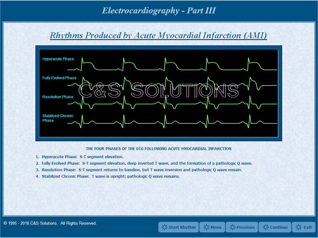 Myocardial Infarction Treatments Of Myocardial Infarction