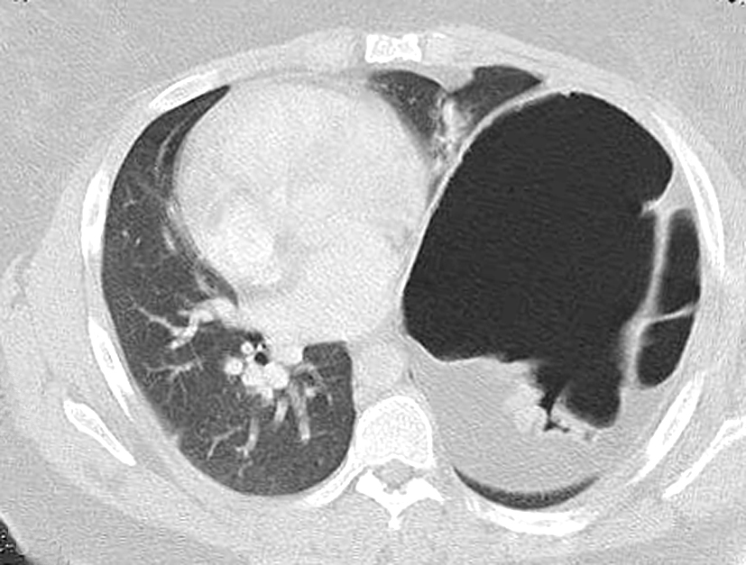 Severe Diaphragmatic Eventration