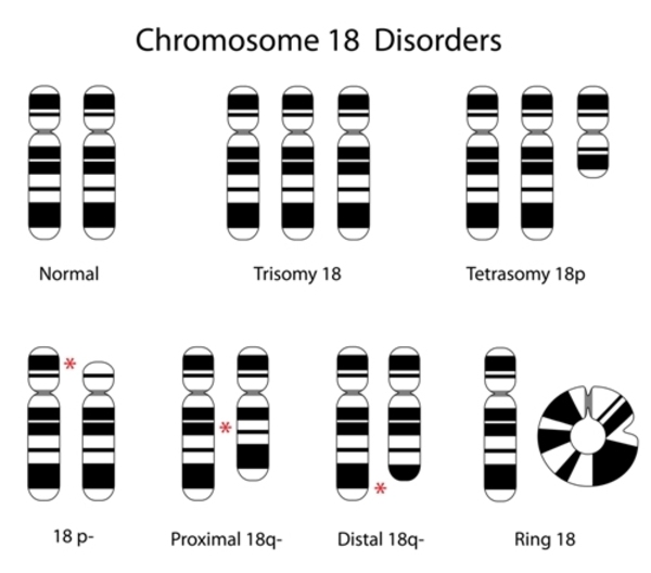 Distal 18q deletion syndrome CtsQena