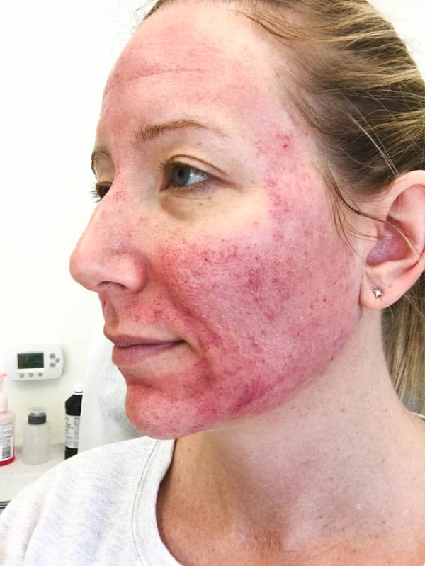 Facebook gives people the power to share and makes the world more open and connected. Microneedling for Acne Scars changed my skin and my life!
