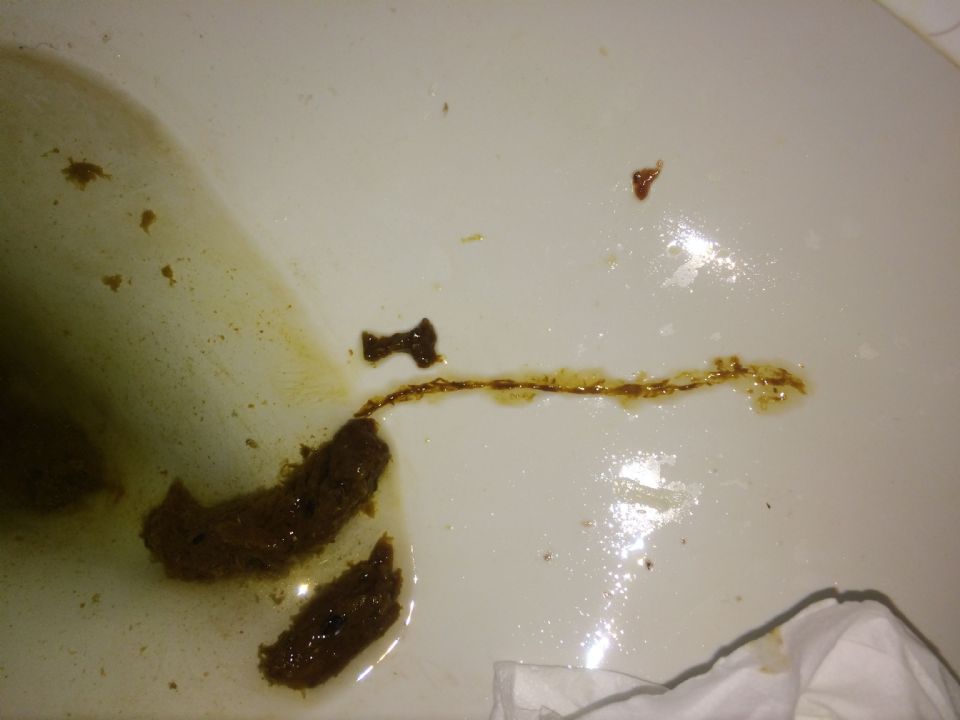 Best Mucus Strands In Stool in the world Check it out now stoolz