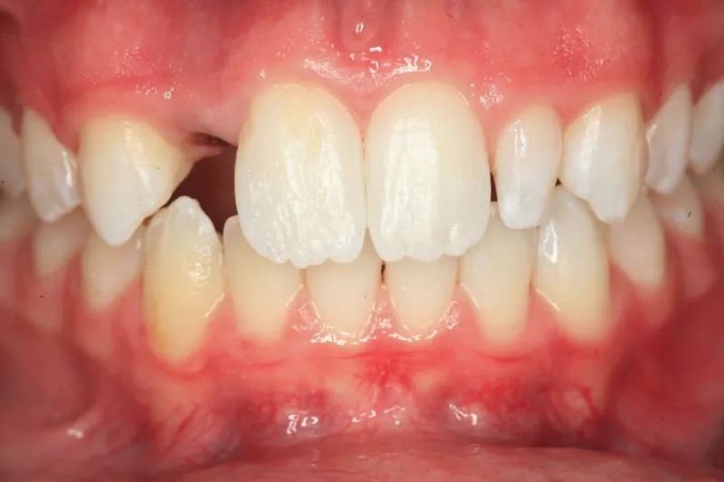 Discover your permanent solution to tooth loss with Dr