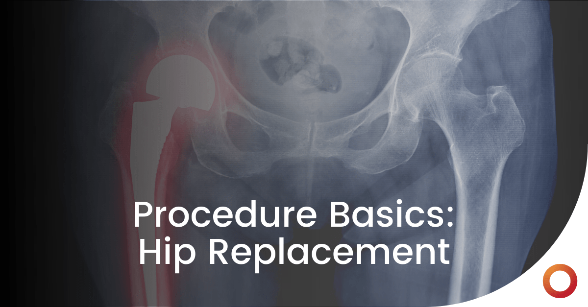 Procedure Overview Hip Replacement Curvo