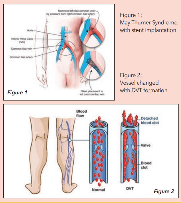 Illiac Vein Compression Can Lead to More Blood Clots CVM