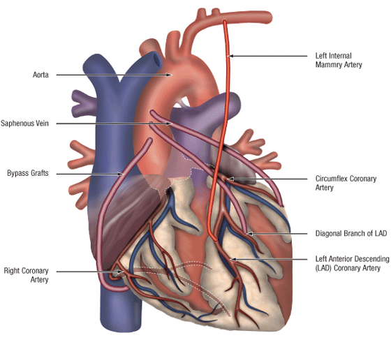 What Is A 5 Way Heart Bypass at Ronald Pancoast blog