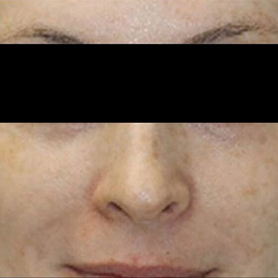 Safe Tattoo Removal & Skin Revitalization MedLite® C6