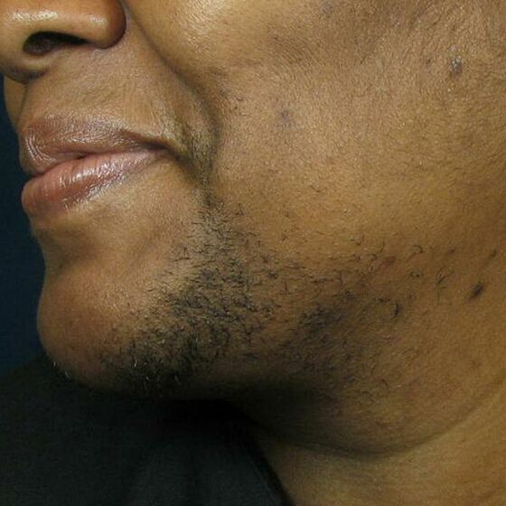 Laser Hair Removal Face Before And After / My Face Felt Like It Was On