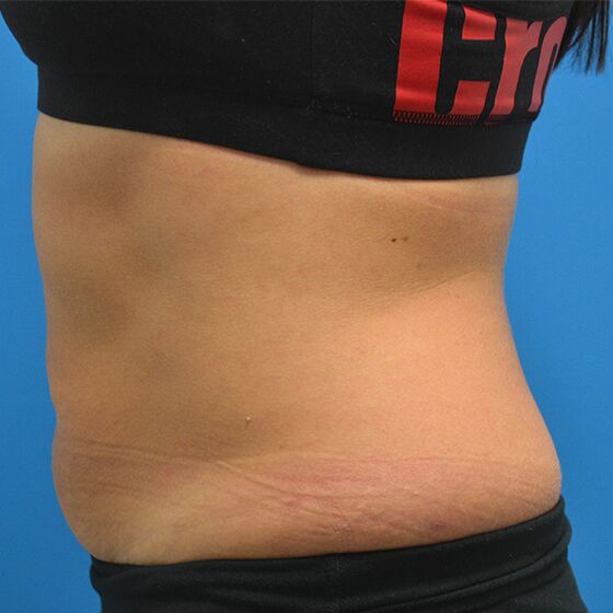 NonInvasive Body Contouring Treatment Cynosure