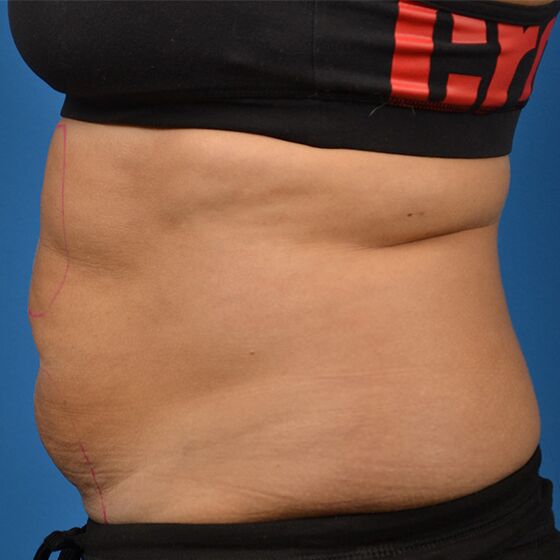 NonInvasive Body Contouring Treatment Cynosure