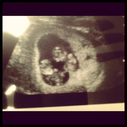 Preeclampsia During the Twin Pregnancy