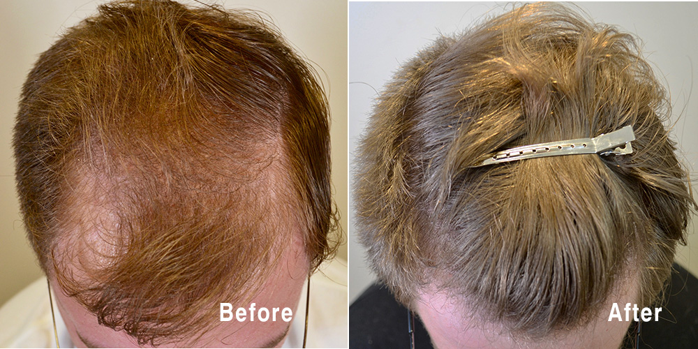 Buy Stop And Reverse Hair Loss Online Daily Chemist
