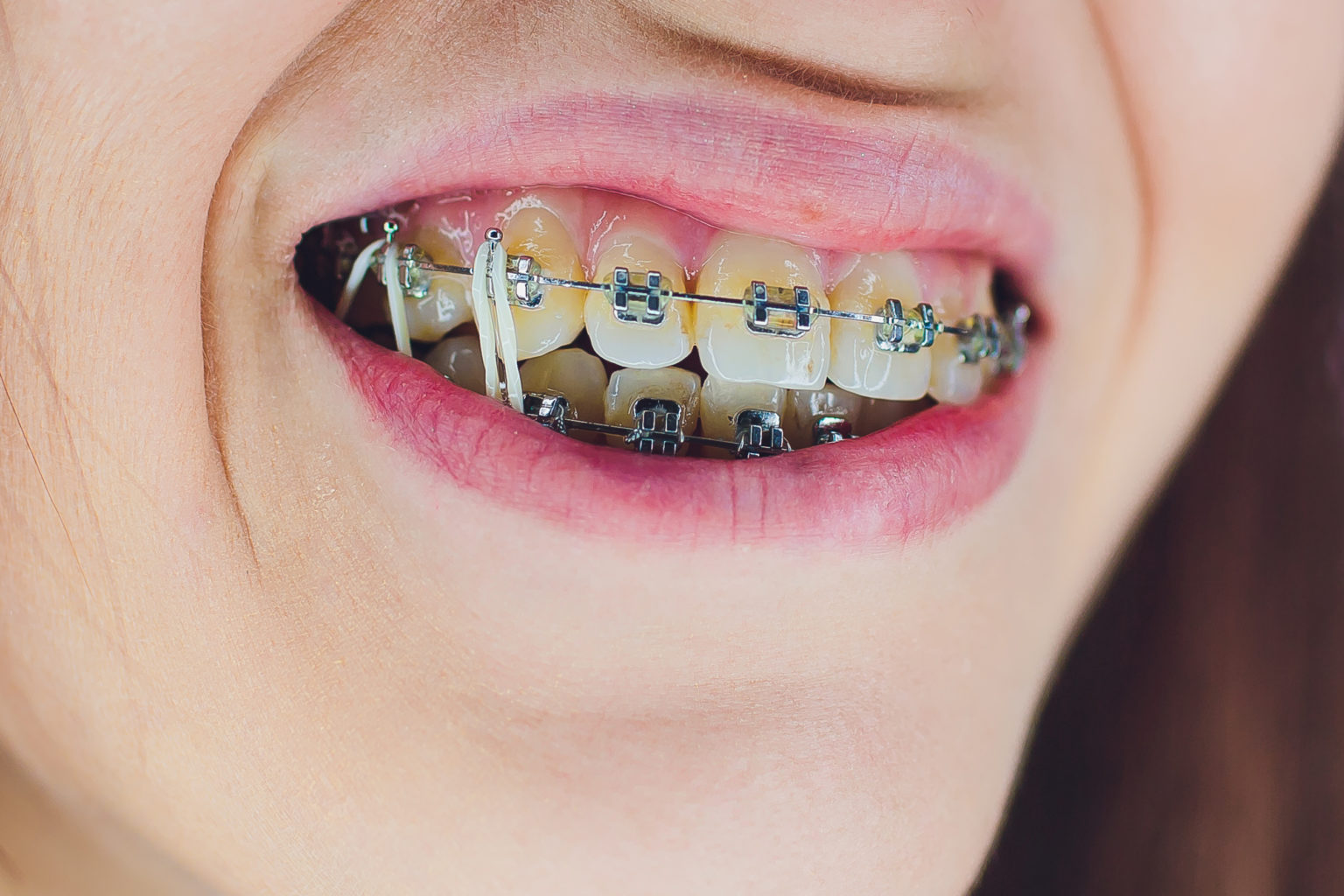 Braces in Irving Do I Need to Wear Elastics? Bite Misalignment