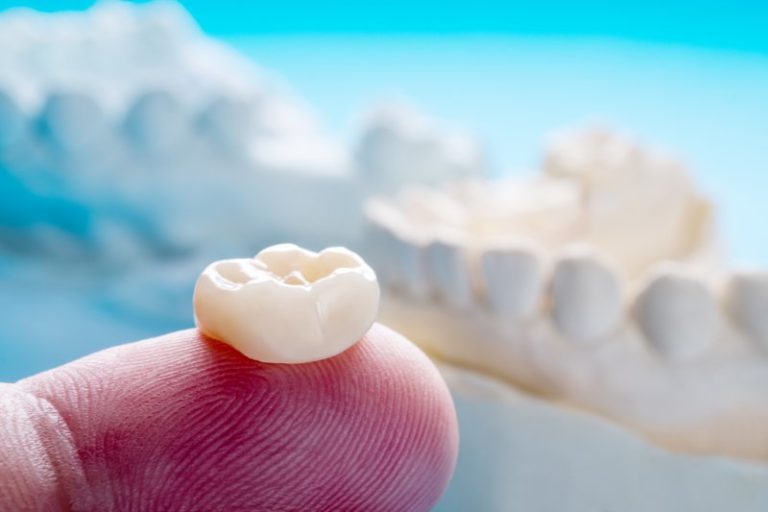 How Long Do Dental Crowns Last? North Dallas Dale W. Greer, DDS