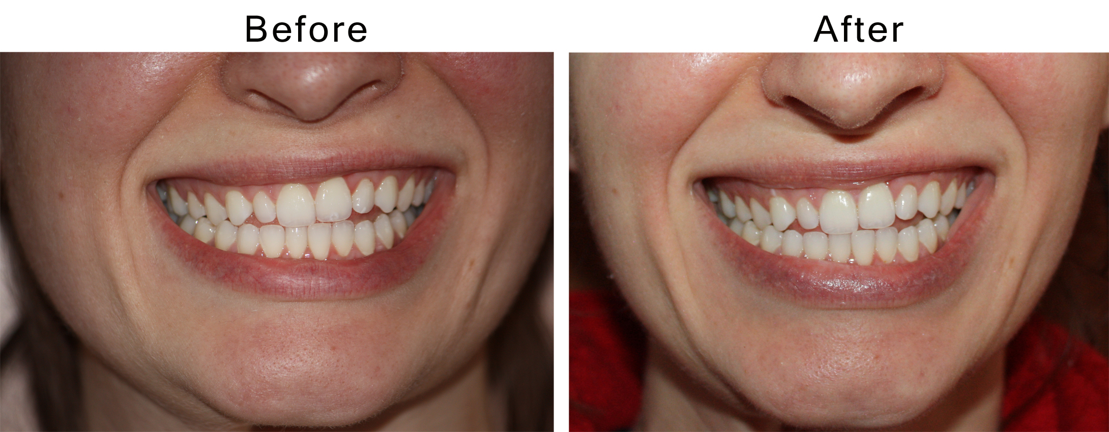 rio teeth whitening kits