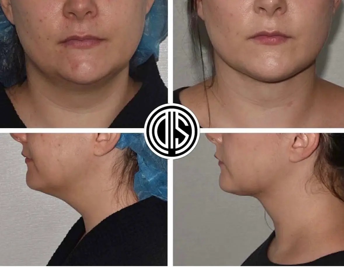 Chin Liposuction NYC: Chin Lipo Cost | Double Chin Lipo Cost