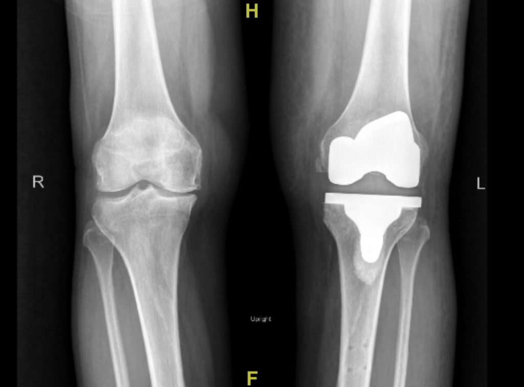 Robotic Assisted Total Knee Replacement Darwin Chen, MD
