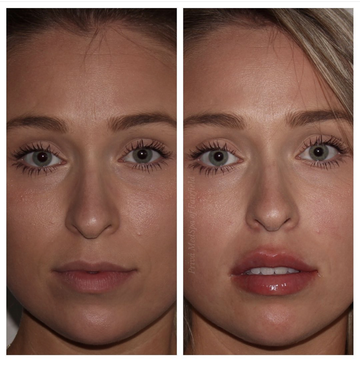 Best Lip Augmentation Fairfield Lip Filler Westport