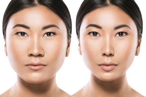 How is an Asian Rhinoplasty Performed? Dr. Anthony Corrado