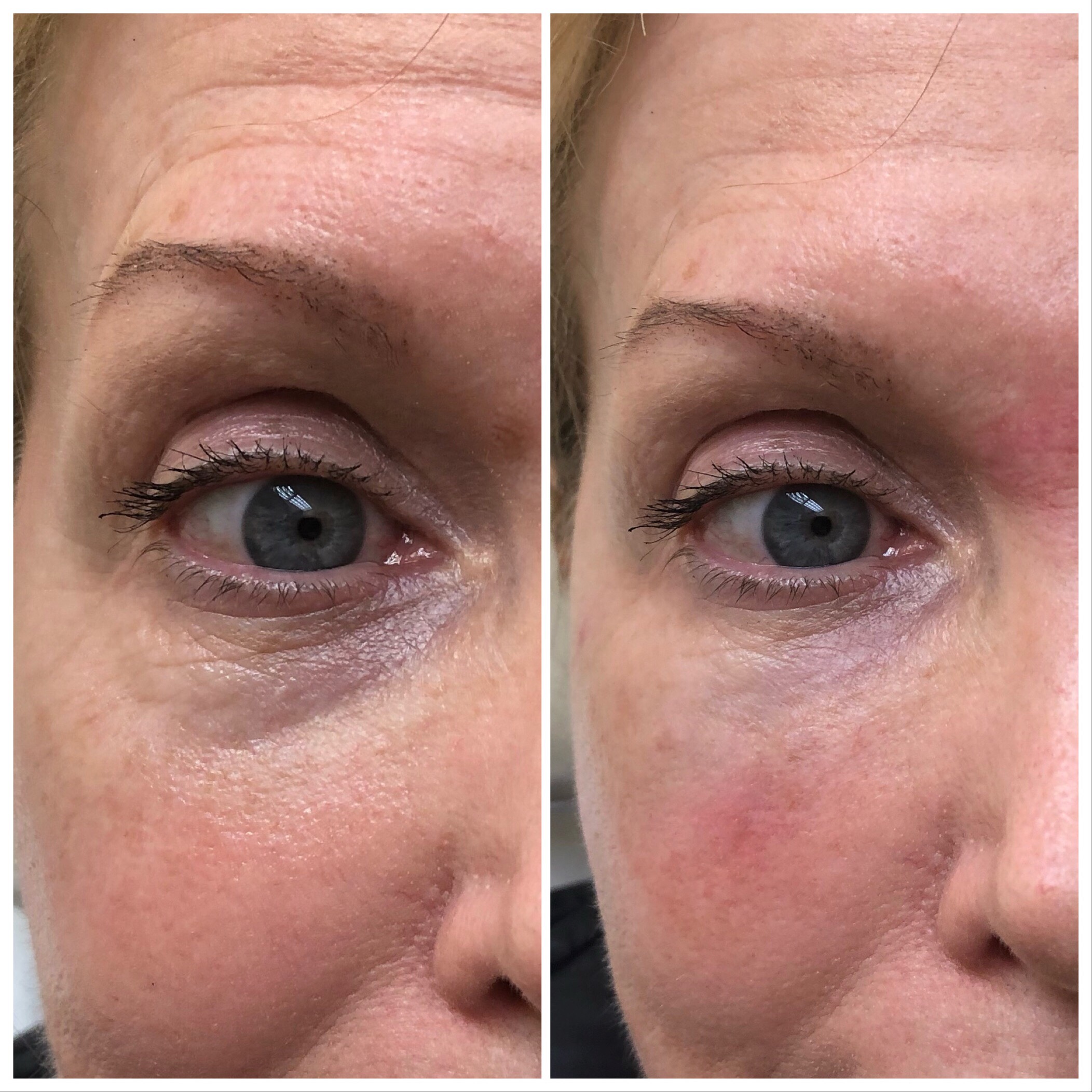 B&A Under Eye Filler Gallery Dr. Hardik Doshi in Brooklyn