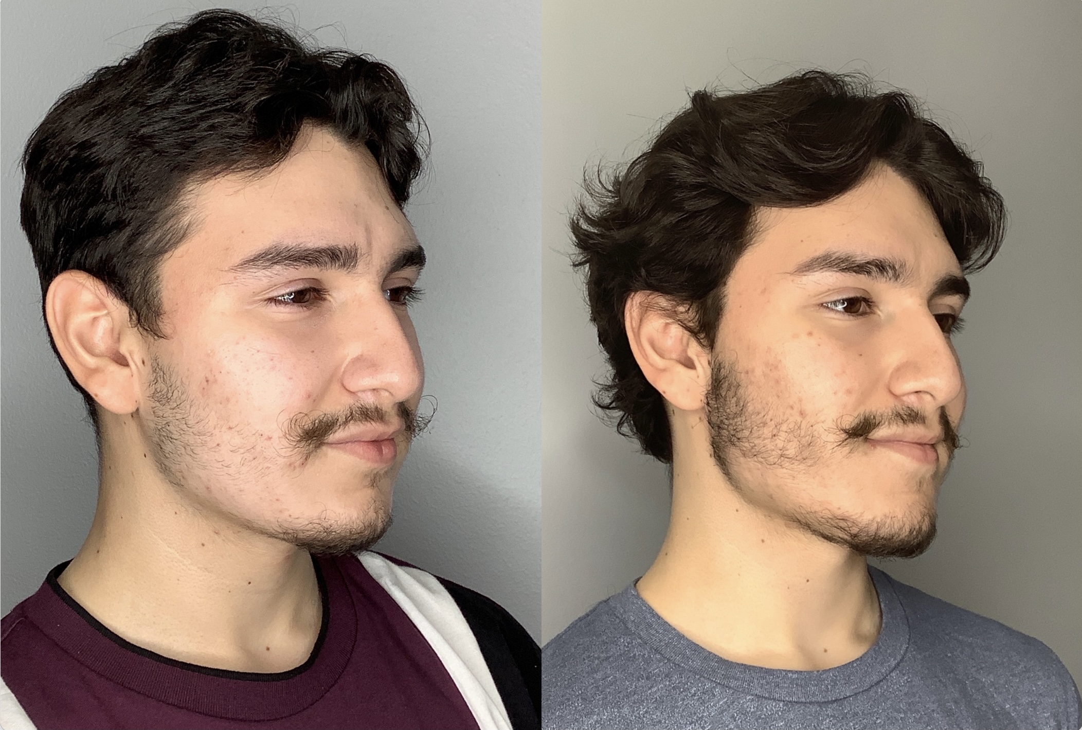 Buccal Fat Removal Before & After Photos Arroyo Plastic Surgery