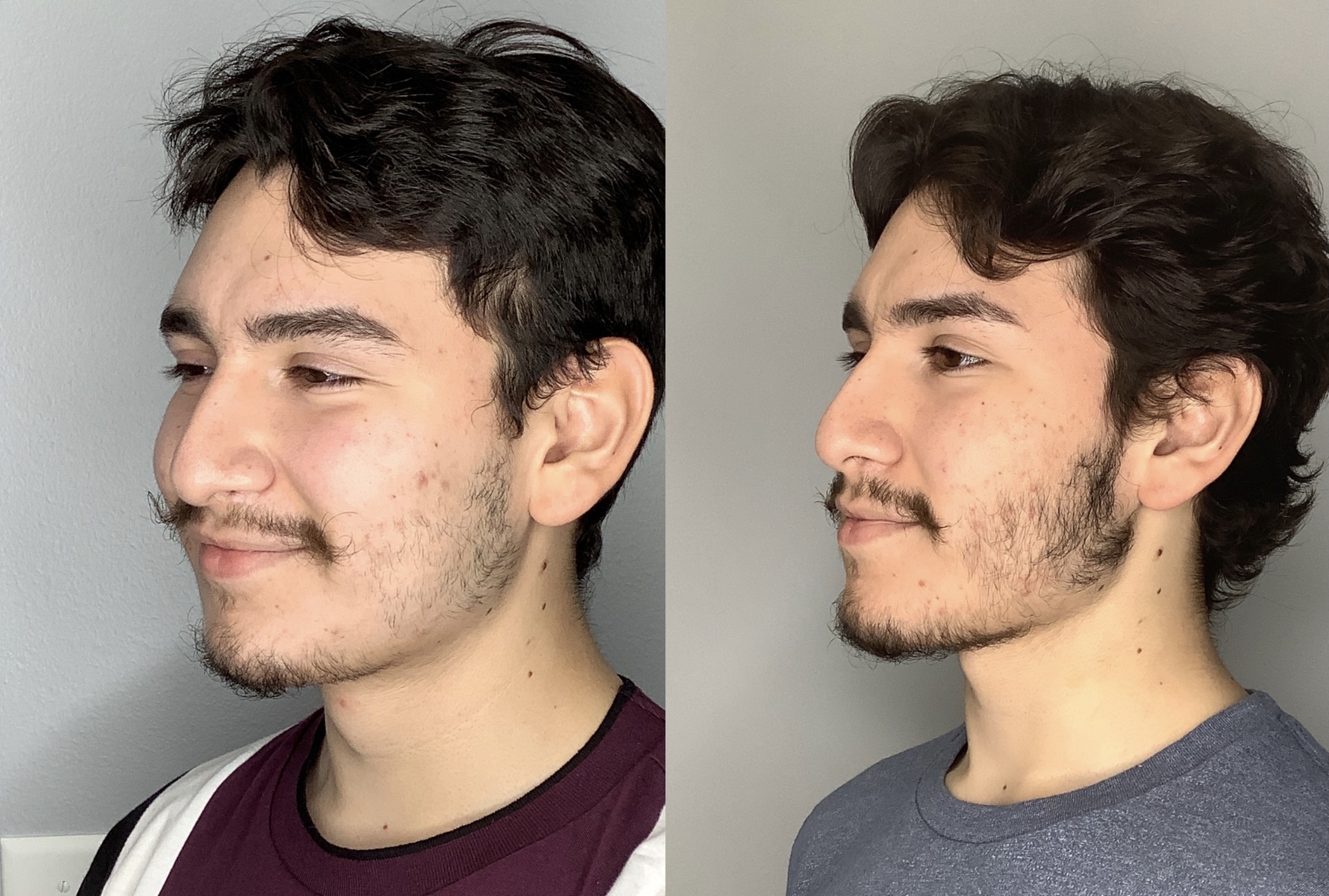 Buccal Fat Removal Before & After Photos Arroyo Plastic Surgery