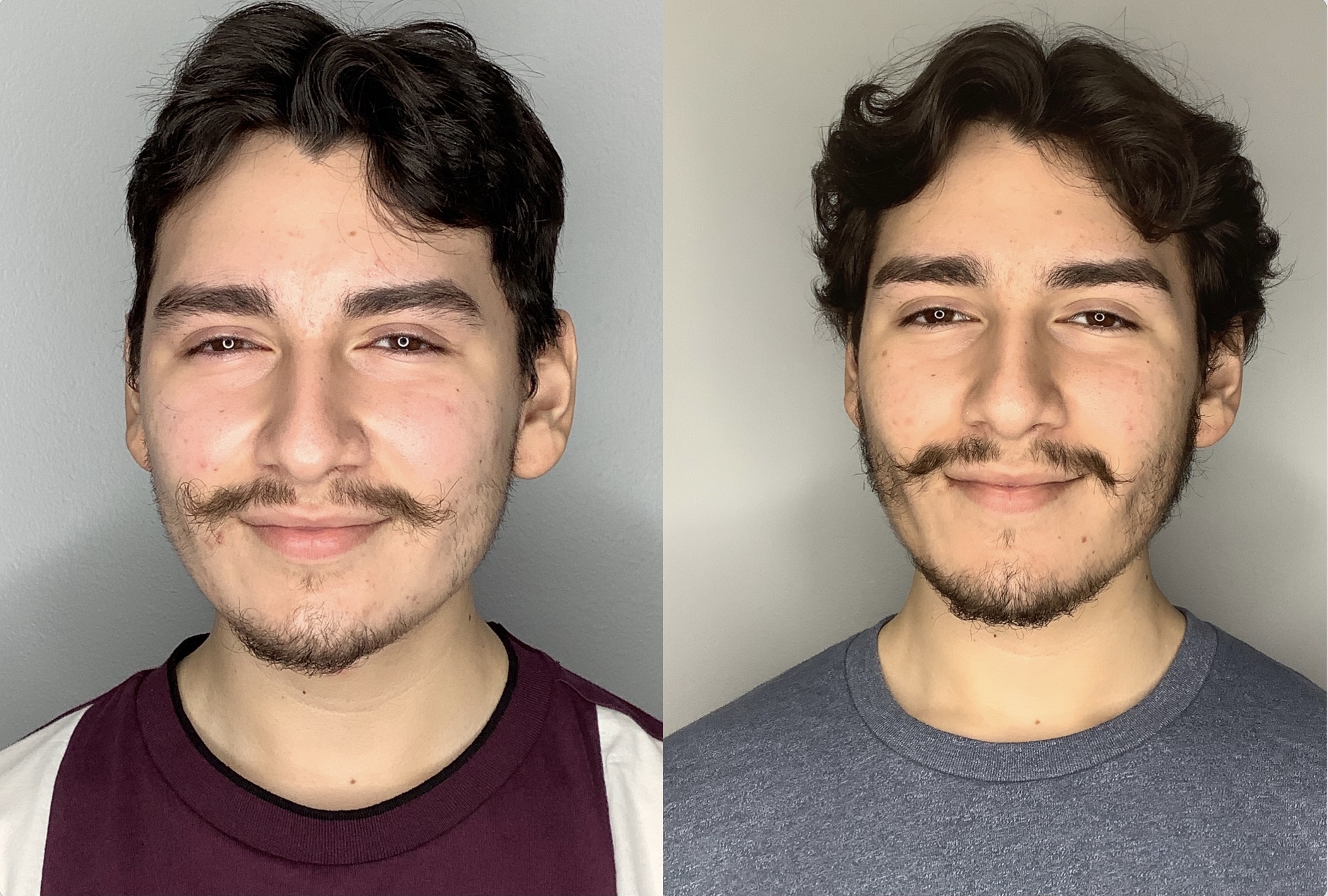 Buccal Fat Removal Before & After Photos Arroyo Plastic Surgery