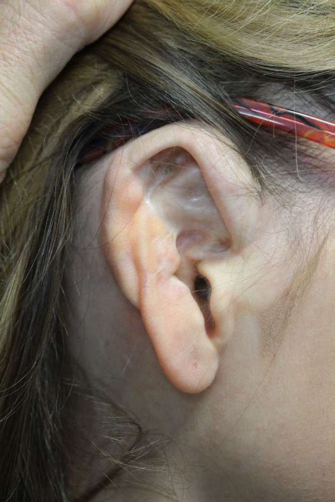 Failed Ear Surgery expert correction of common & unusual otoplasty faults
