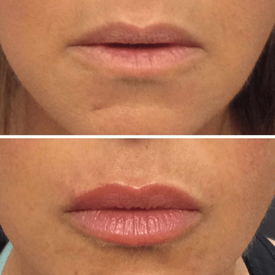 Los Angeles Volbella Lip Injections David Ghozland