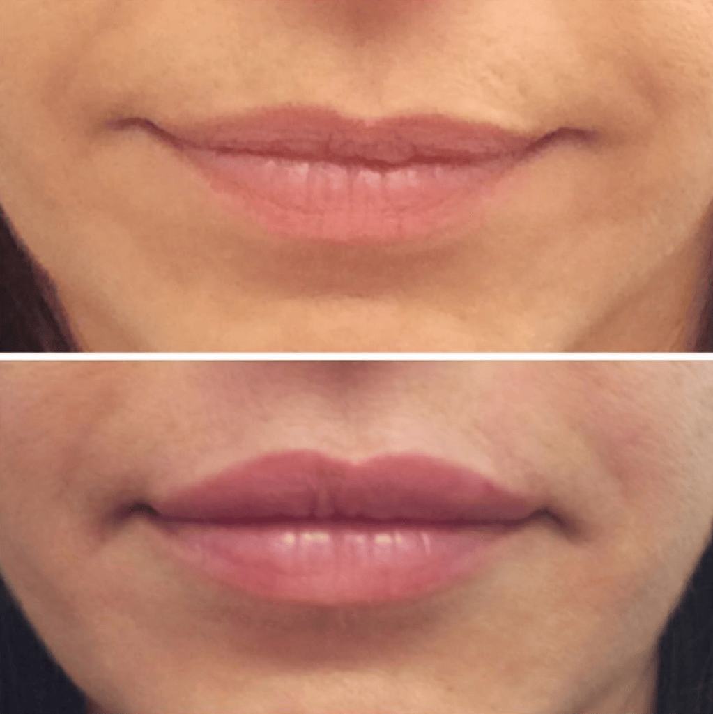 Los Angeles Volbella Lip Injections David Ghozland