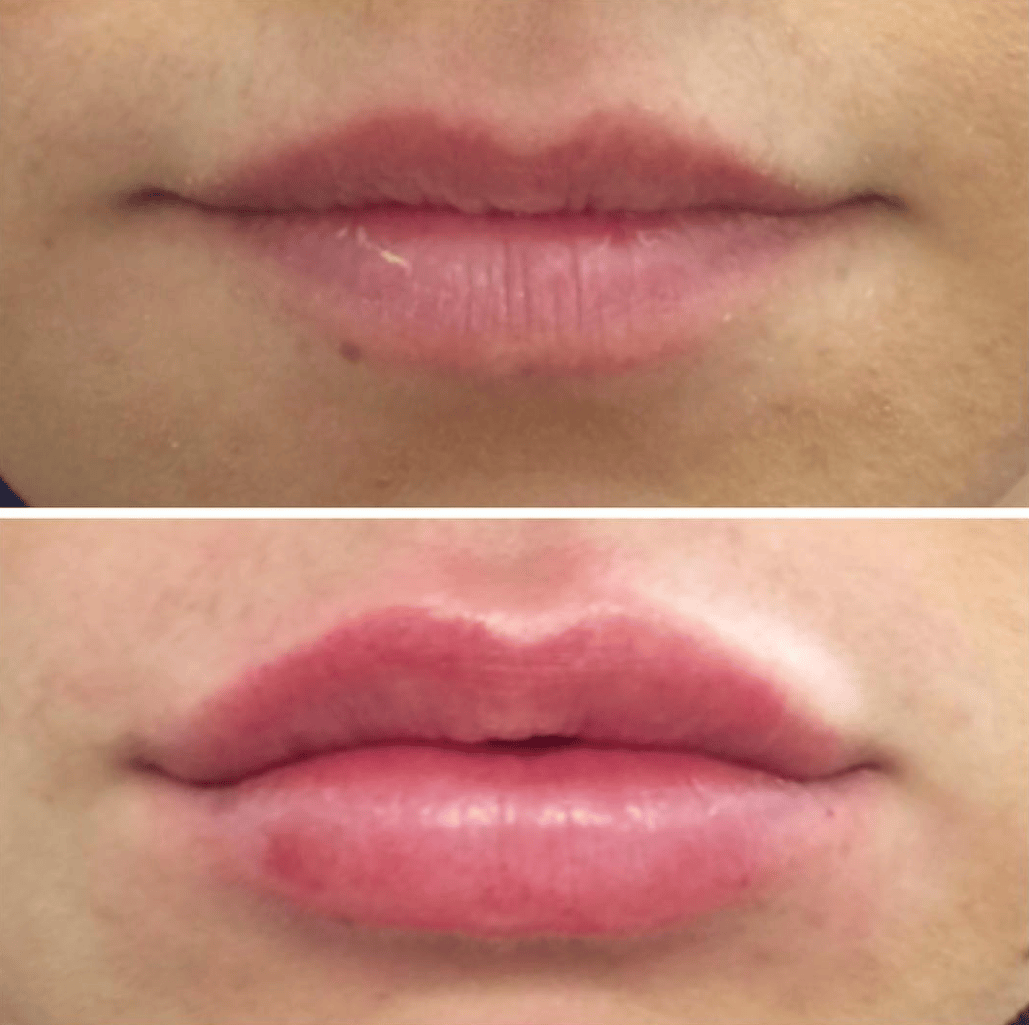 Los Angeles Volbella Lip Injections David Ghozland
