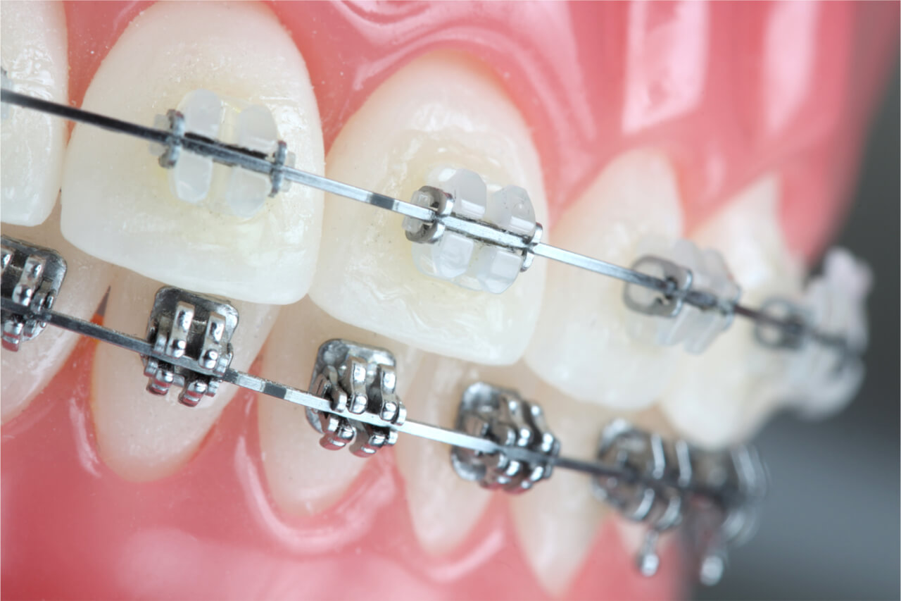 What is the average cost of different braces types?