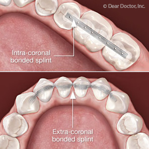 How To Stabilize Loose Teeth At Home inspire ideas 2022